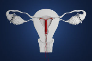 3d rendered illustration of an intra-uterine device.