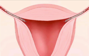 medical illustration of essure coil inserted in the fallopian tube